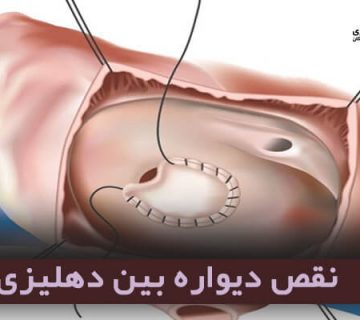 نقص دیواره بین دهلیزی (Atrial septal defect-ASD)