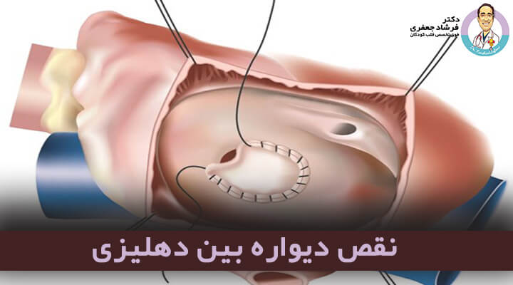نقص دیواره بین دهلیزی (Atrial septal defect-ASD)