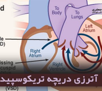 آترزی دریچه تریکوسپید