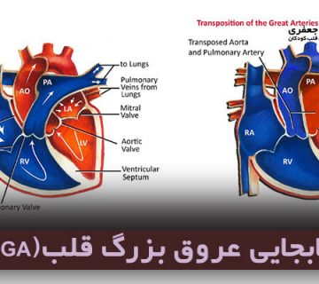 جابجایی عروق بزرگ قلب(transposition of great arteries-TGA)