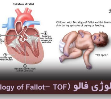 تترالوژی فالو