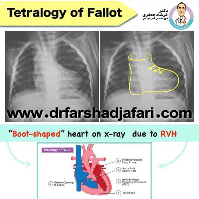 تترالوژی فالو دکتر فرشاد جعفری